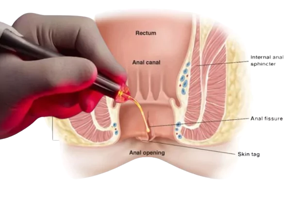 Anal Fistül Tedavisi