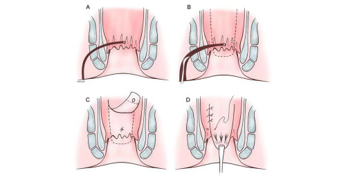 Anal Fistül Tedavisi