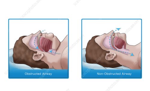 Obezite Ameliyatı Sadece Kilo Vermek Değil, Uyku Kalitesini de Artırıyor
