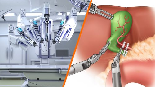 Robotik Cerrahi ve Laparoskopik Cerrahi: Hangisi Daha Güvenli? – Doç. Dr. Vahit Mutlu (2026)