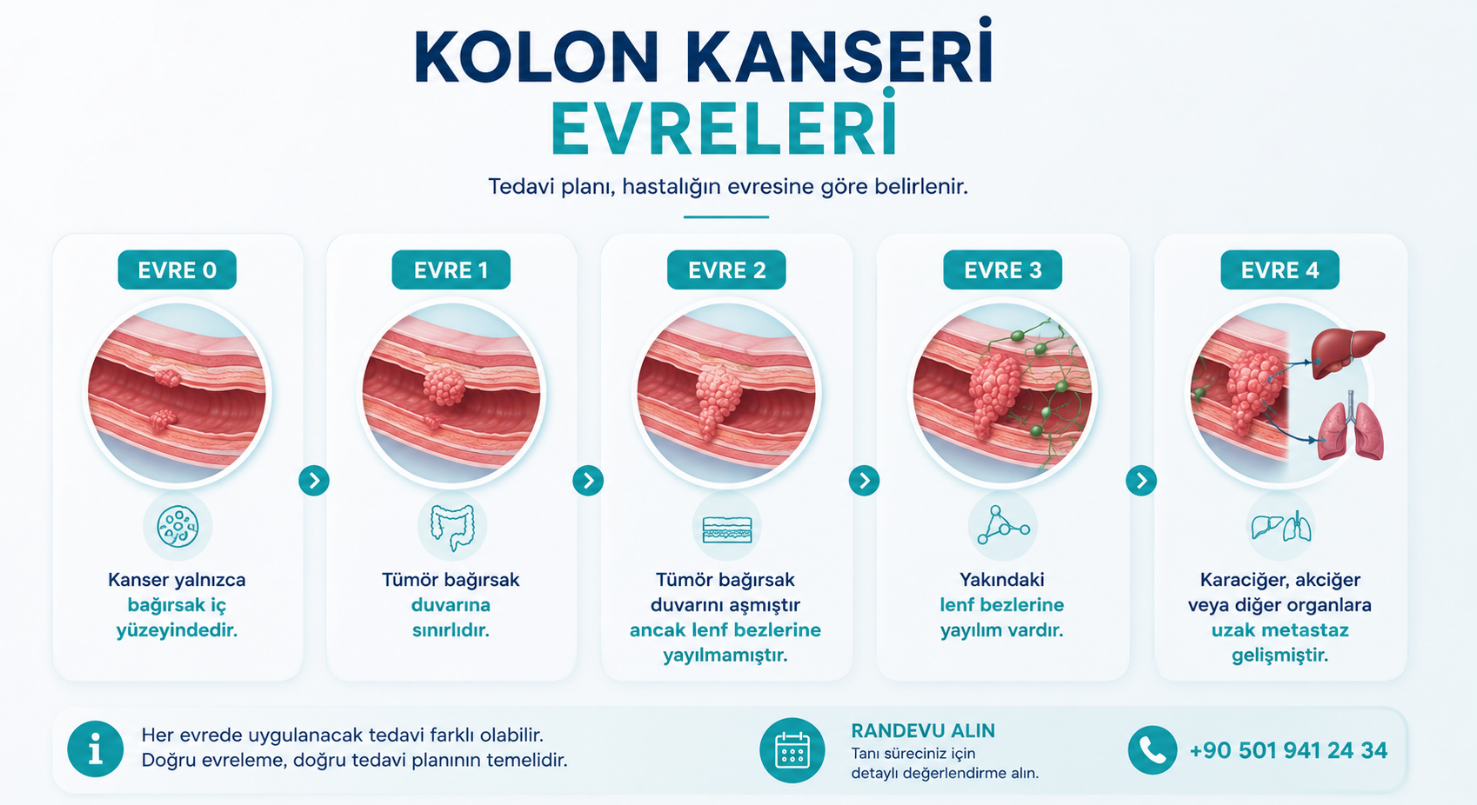 Kolon kanseri evreleri