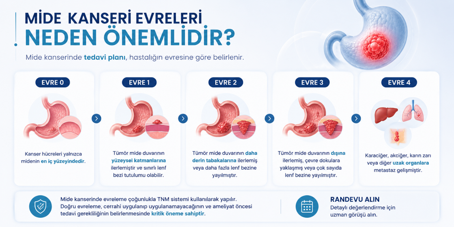 Mide kanseri evreleri